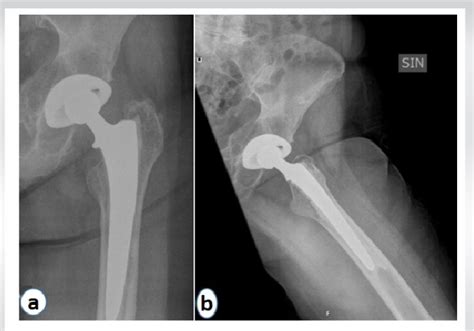 A And B Pre Operative Images With Signs Of Loosening Of The Left Hip