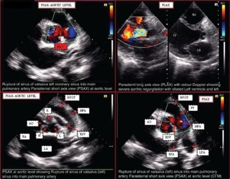Follow echo chamber to never miss another show. Transthoracic two-dimensional echocardiogram showing th ...