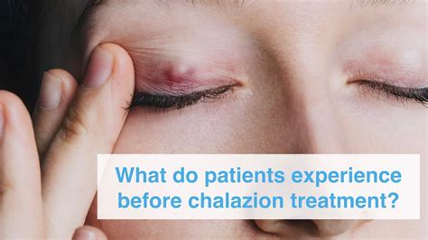 What Do Patients Experience Before Chalazion Treatment Youtube