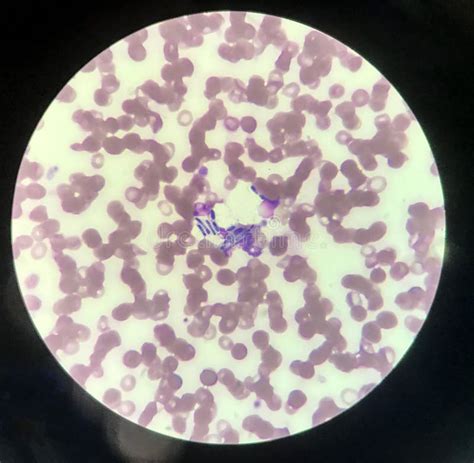 Yeast Cells Phagocytosis By White Blood Cell In Blood Smear Stock Photo