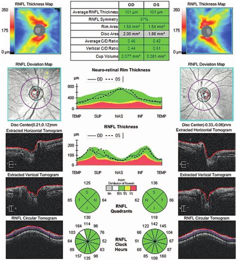Optical Coherence Tomography Of The Optic Nerve Head And Retinal Nerve