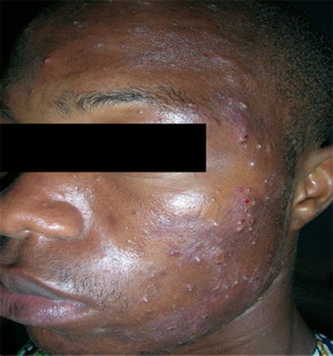 Nodular acne and cystic acne. Epidemiological and Clinical Aspects of Acne in the ...