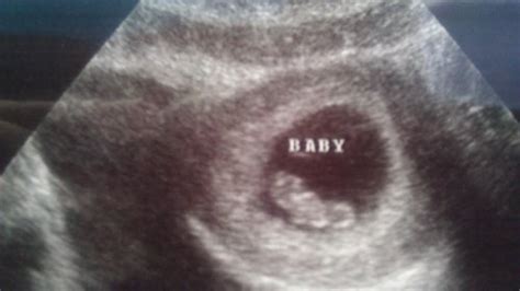 Share Your 8 9 Weeks Ultrasound Pics And Baby Bumps Here Babycenter