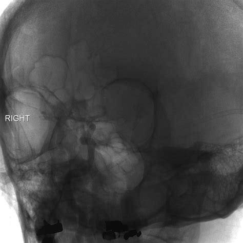 Normal Cerebral Angiogram Four Vessel Dsa Image