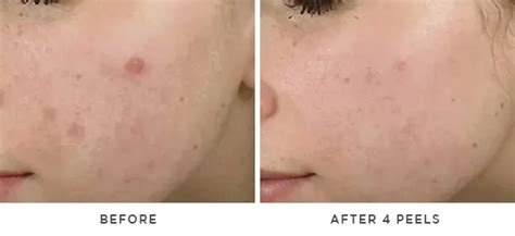 Chemical Peels Houston Tx Dermatologist