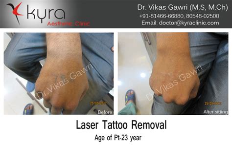 Update More Than 72 Tattoo Removal Before After Pictures Best