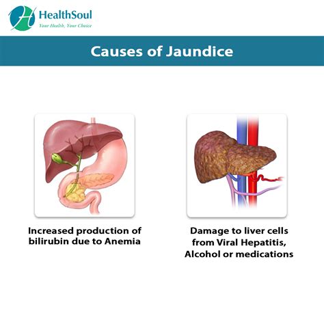Jaundice Causes And Treatment Healthsoul