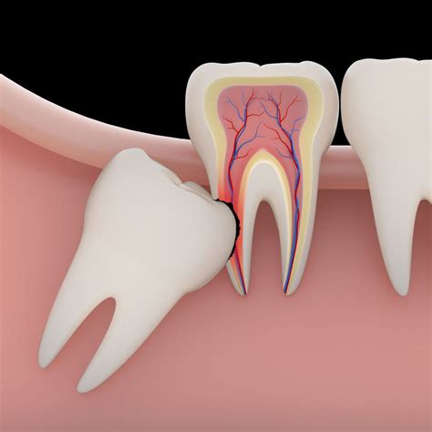 Wisdom Teeth Removal Scottsdale Az Phoenix Az Dental Works