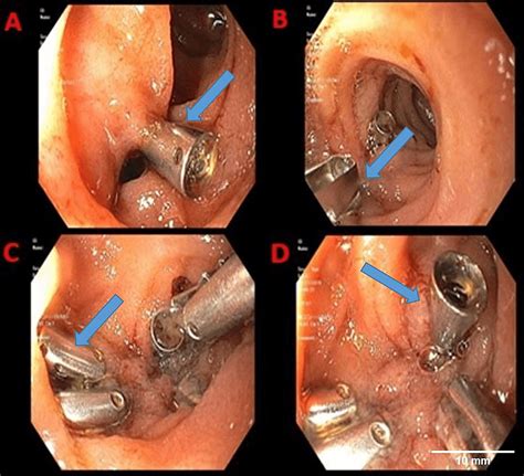 Cureus Endoscopic Management Of Jejunal Perforation During Endoscopic