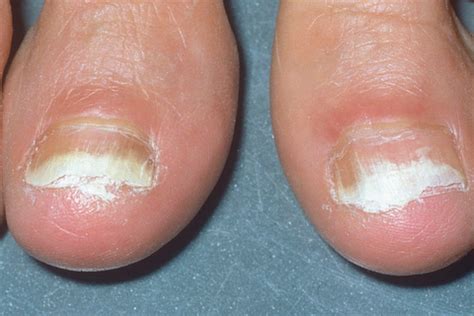 Gradually, this spreads deeper into the nail, causing discoloration, thickening, and crumbling of the nail. 7 Effective Toenail Fungus Treatments - Best Natural Home ...