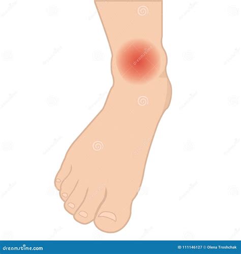 Swelling Of The Feet And Ankles From Infected Or Injury Cartoon Vector