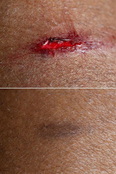 Superficial Wound Before And After A Connective Tissue Treatment Stock
