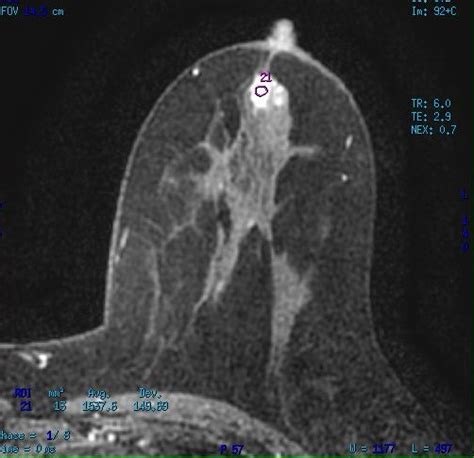 Intraductal Papilloma Breast MRI Image Radiopaedia Org