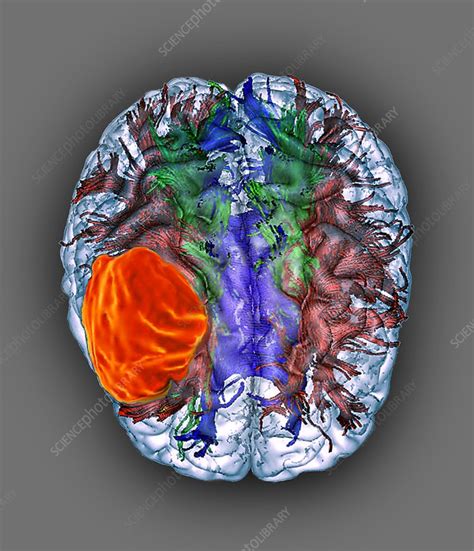 Glioblastoma Brain Cancer Dti Mri Scan Stock Image C0389356