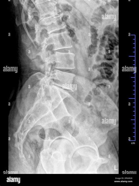 Radiografía De La Pelvis Y La Columna Vertebral Vista Lateral