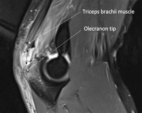 9 Complete Rupture Of The Triceps Tendon On Magnetic Resonance Imaging