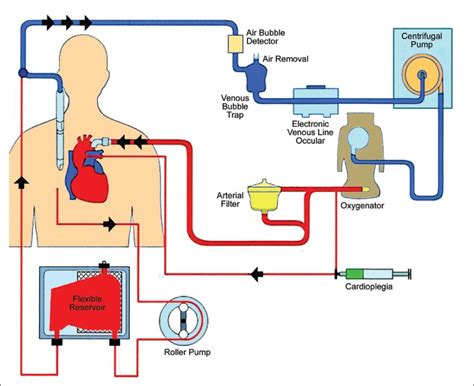 Cardiopulmonary Bypass Diagram