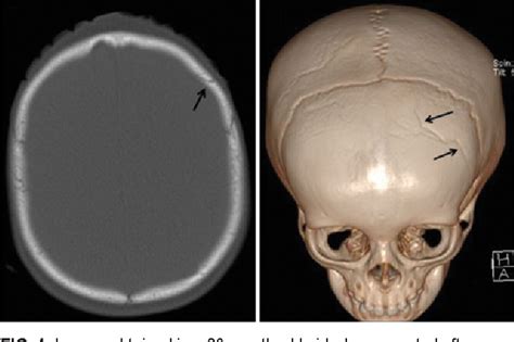 Figure 4 From Pediatric Skull Fracture Diagnosis Should 3d Ct