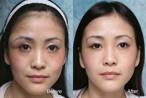 Asian Eyelid Surgery Do You Need It Blepharoplasty Beverly Hills