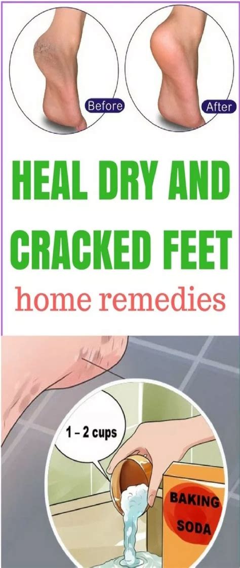 Heal Dry And Cracked Feet Home Remedies Cracked Feet Dry Cracked Feet