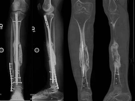 Radiographs Showing The Clamshell Osteotomy Fixed With An Download