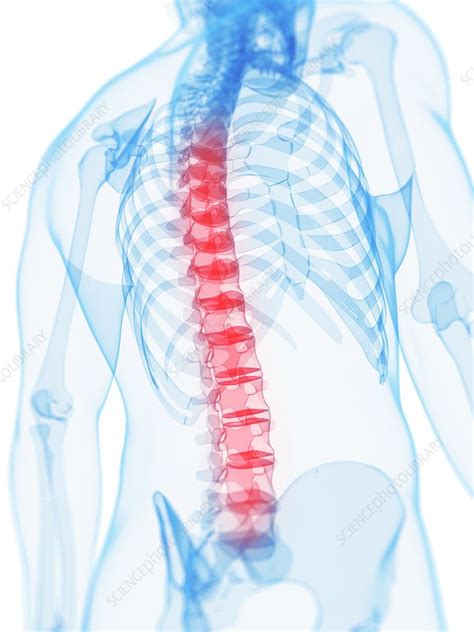 Back Pain Conceptual Artwork Stock Image F0062694 Science Photo