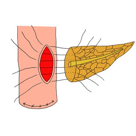 Penetrating Suture Pancreatojejunostomy The Pancreatic Anastomosis