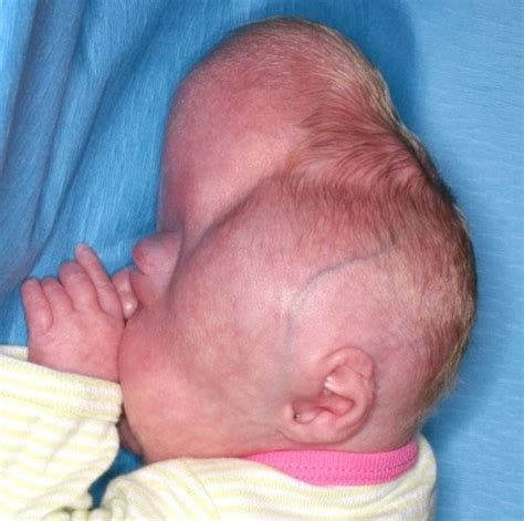 Baby Who Had The Most Misshapen Head Doctors Had Ever Seen Undergoes