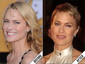 Robin Wright Plastic Surgery Before And After Plastic Surgery Magazine