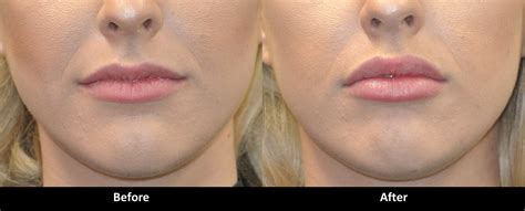 1 Syringe Of Juvederm In Lips Before And After