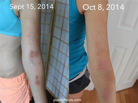 Real Life Eczema Update 2 Mrt Food Testing And Contact Dermatitis