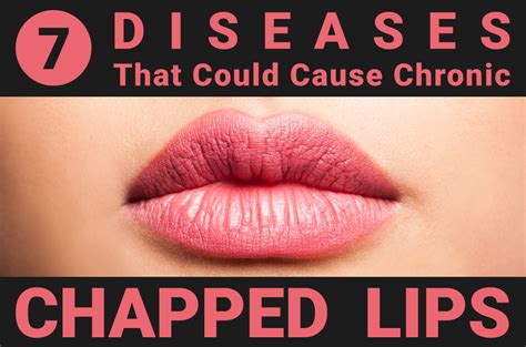 Seven Diseases That Could Cause Chronic Chapped Lips Cheilitis