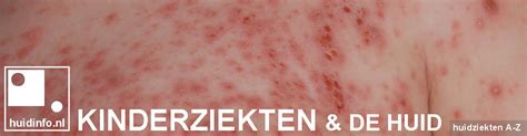 Kinderziekten En De Huid Huidinfonl Van De Dermatoloog