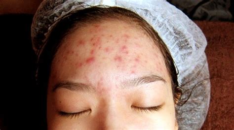 Forehead Acne Pictures Causes And Treatment 2018 Updated
