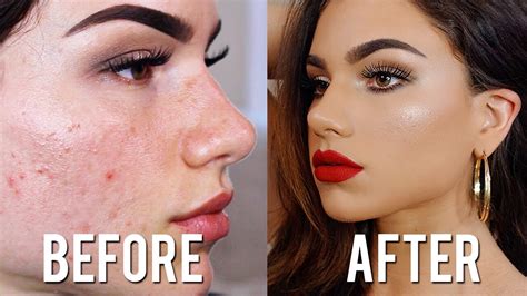 How To Cover Acne And Scars With Makeup Full Coverage