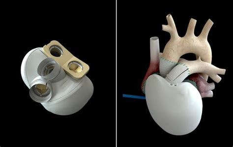 The First Self Regulating Artificial Heart 2015 Technology Medical