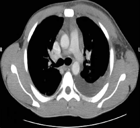 Ct Chest Bilateral Effusion Left More Than Right Note Diffuse Soft