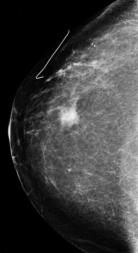 Invasive Lobular Carcinoma Of The Breast Spectrum Of Mammographic Us