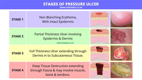 Stages Of Pressure Ulcer