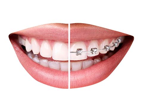 Pngpix Com Teeth With Braces Png Transparent Image Soni Dental Group