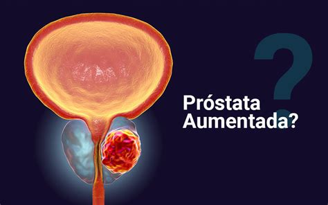 Conheça Os Tratamentos Para Reduzir O Tamanho Da Próstata