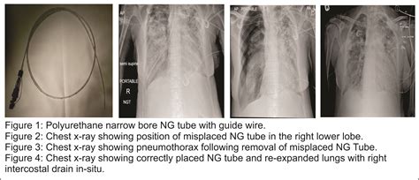 Pneumothorax From Nasogastric Feeding Tube In A Patient With