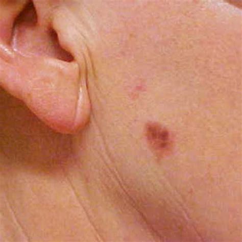 Basal Cell Carcinoma Bcc The Skin Docs