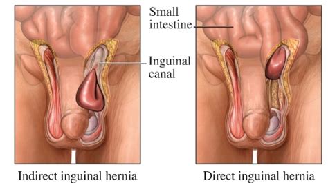 For example, if it occurs in the upper thigh, it's called femoral hernia. Groin Hernia—Adult - Western New York Urology Associates, LLC