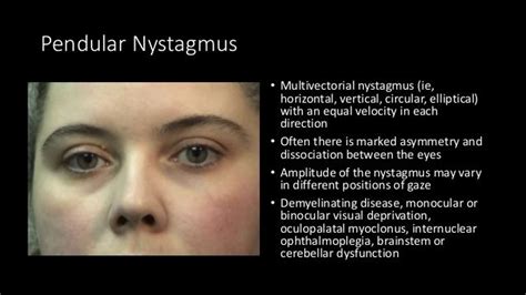 Central Vertigo And Nystagmus