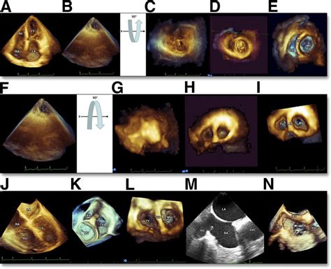 Normal Tricuspid Valve On 3d Echocardiography Download Scientific Diagram