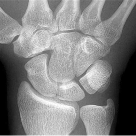 Lunate Bone Morphology And Wrist Arthrosis A Radiographic Study Of The