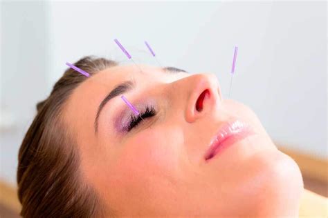 Cosmetic Acupuncture Patricia Mcnab