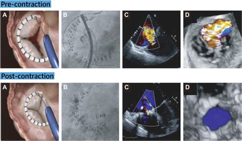 1 Year Outcomes Of Cardioband Tricuspid Valve Reconstruction System