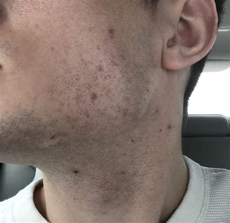 Acne Help With Persistent Cheek Acne Rskincareaddiction
